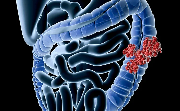 The most updated colectomy techniques in the surgical management of colon cancer