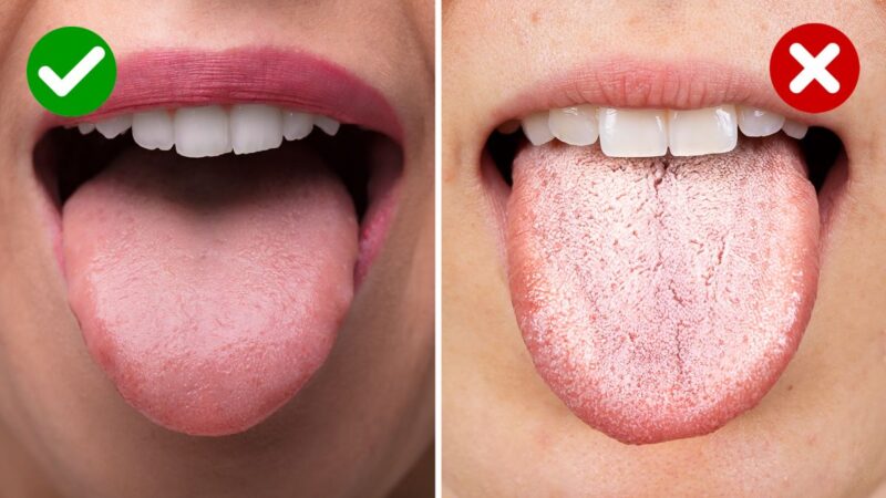 Why is tongue cancer on the rise?