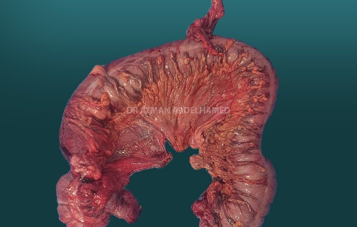 Complete colon resection