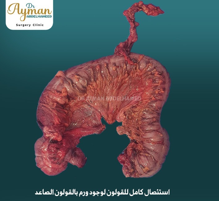 Read more about the article Complete colon resection