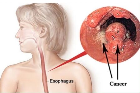 Symptoms and causes of oesophageal cancer