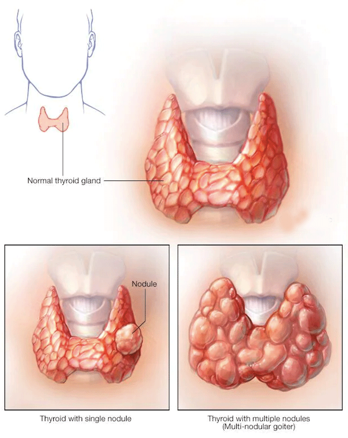 Read more about the article متى نلجأ لاستئصال الغدة الدرقية؟