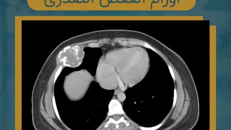 Tumors of the rib cage and ribs