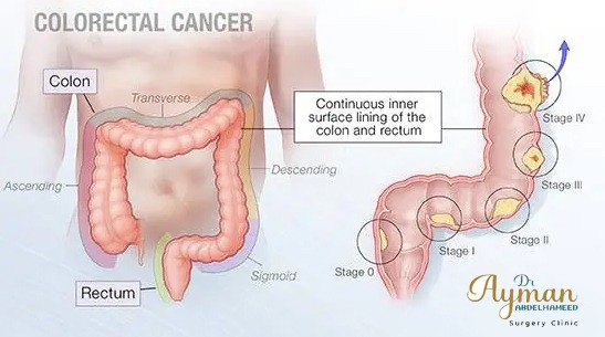 Colorectal cancer