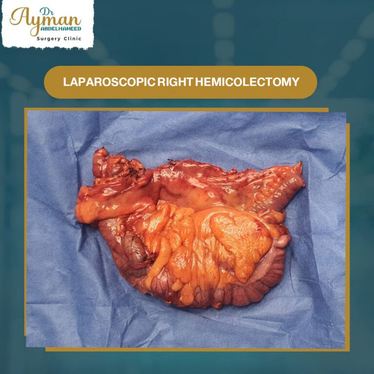 Read more about the article Laparoscopic right hemicolectomy