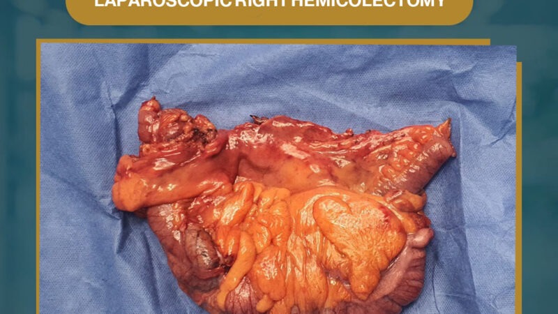 Laparoscopic right hemicolectomy