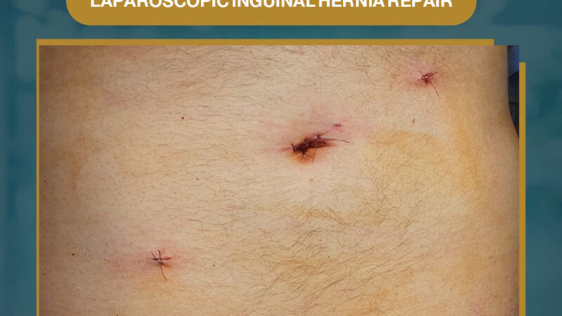 laparoscopic inguinal hernia repair