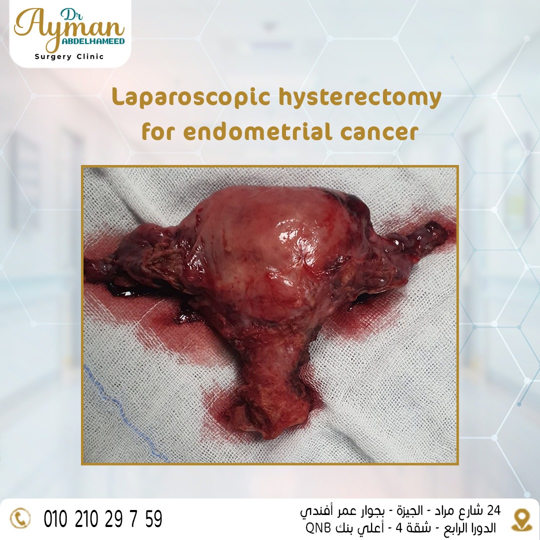 Laparoscopic hysterectomy for endometrial cancer