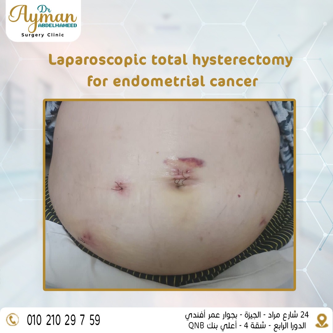 Laparoscopic total hysterectomy