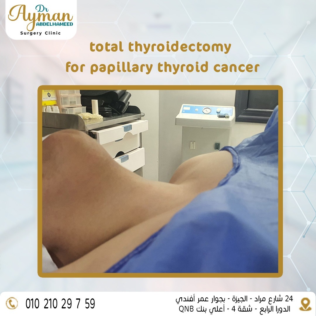 Read more about the article total thyroidectomy for papillary thyroid cancer