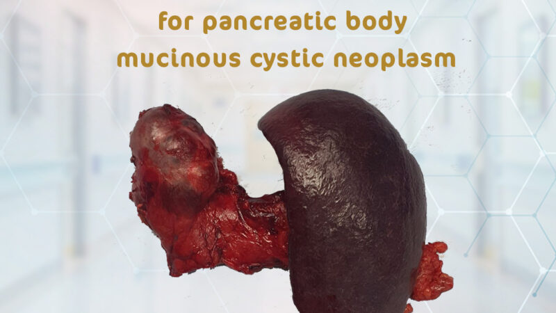 Laparoscopic spleno-pancreatectomy for pancreatic body mucinous cystic neoplasm