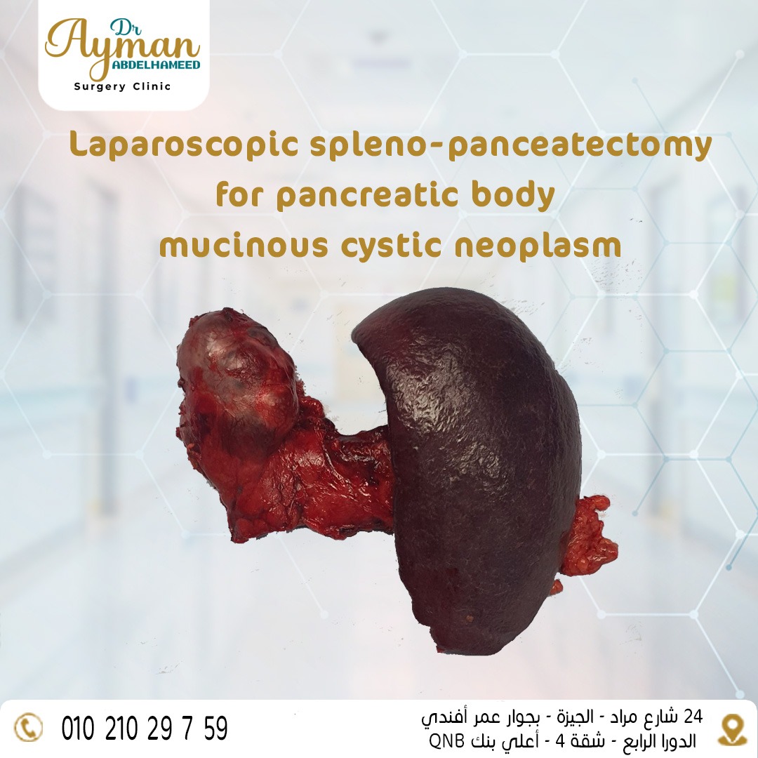 Laparoscopic spleno-pancreatectomy for pancreatic body mucinous cystic neoplasm