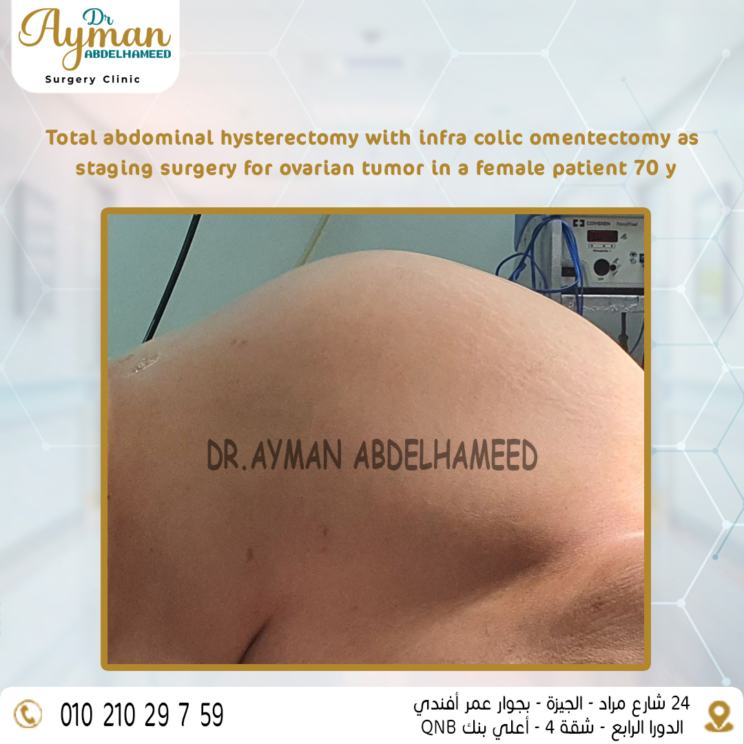 Read more about the article Success Total abdominal hysterectomy