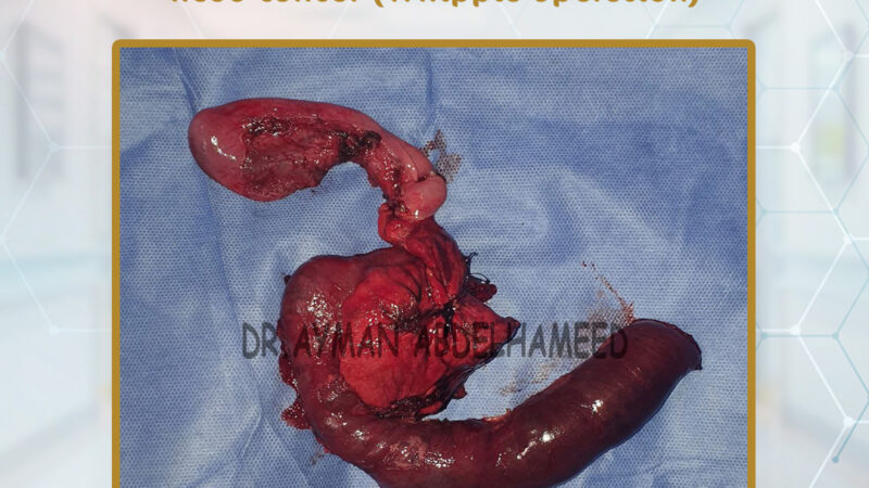 pancreaticodudenectomy for pancreatic head cancer