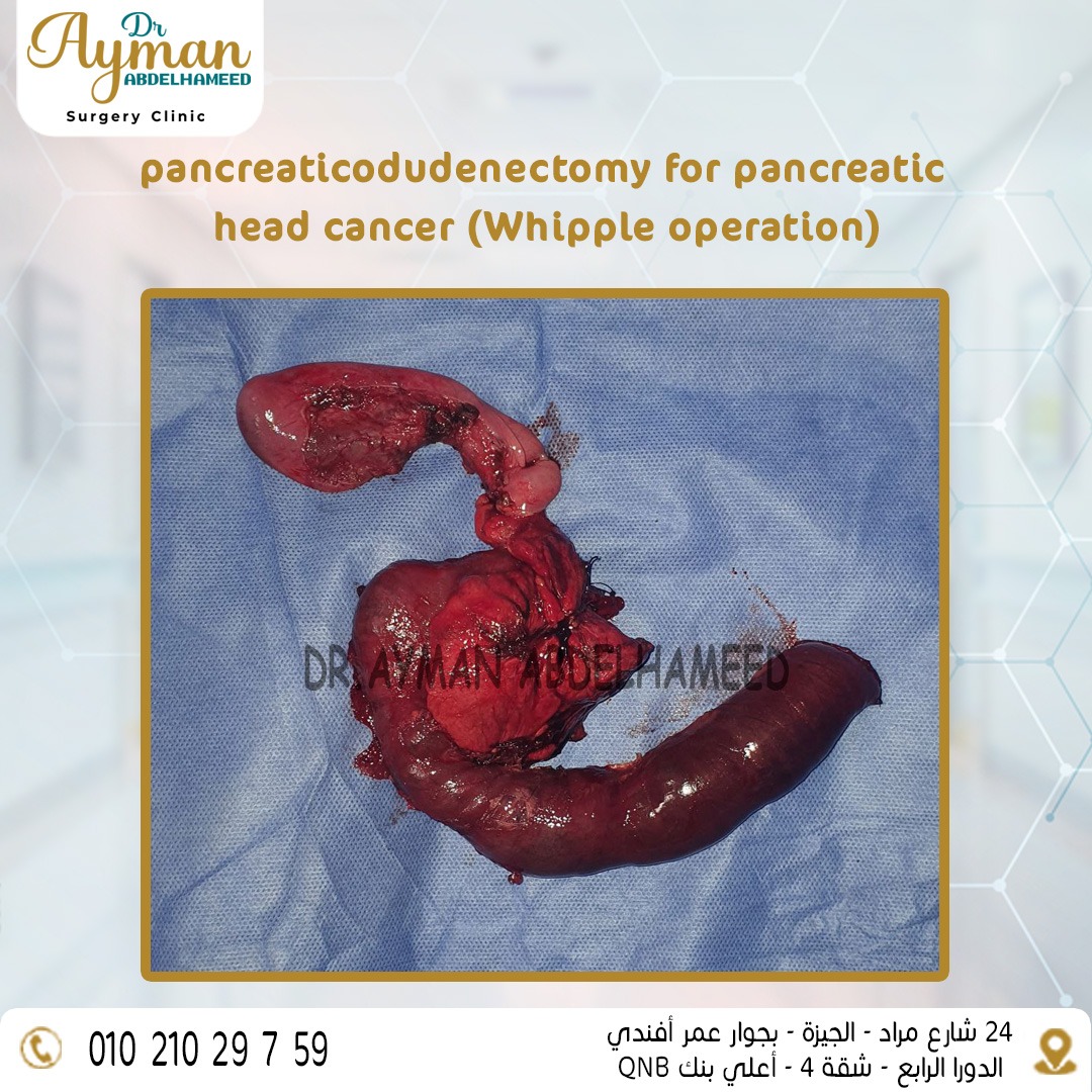 Read more about the article pancreaticodudenectomy for pancreatic head cancer