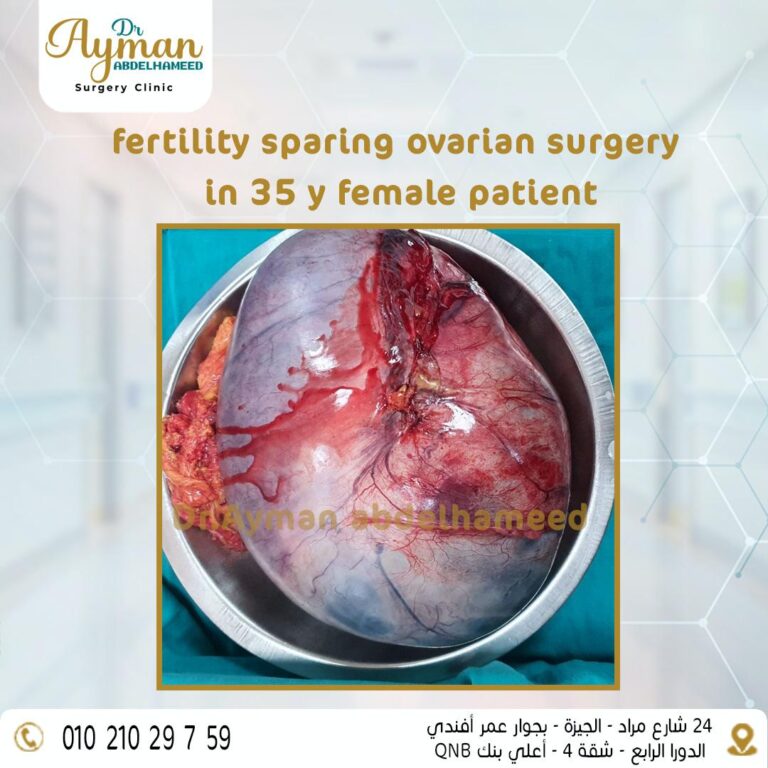 Read more about the article fertility sparing ovarian surgery in 35 y female patient