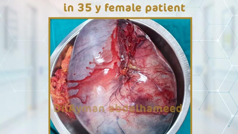 fertility sparing ovarian surgery in 35 y female patient