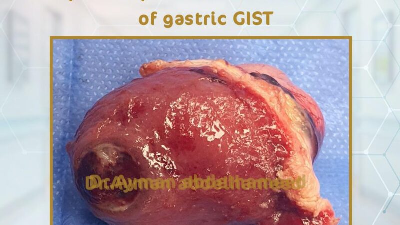 laparoscopic hand free resection of gastric GIST