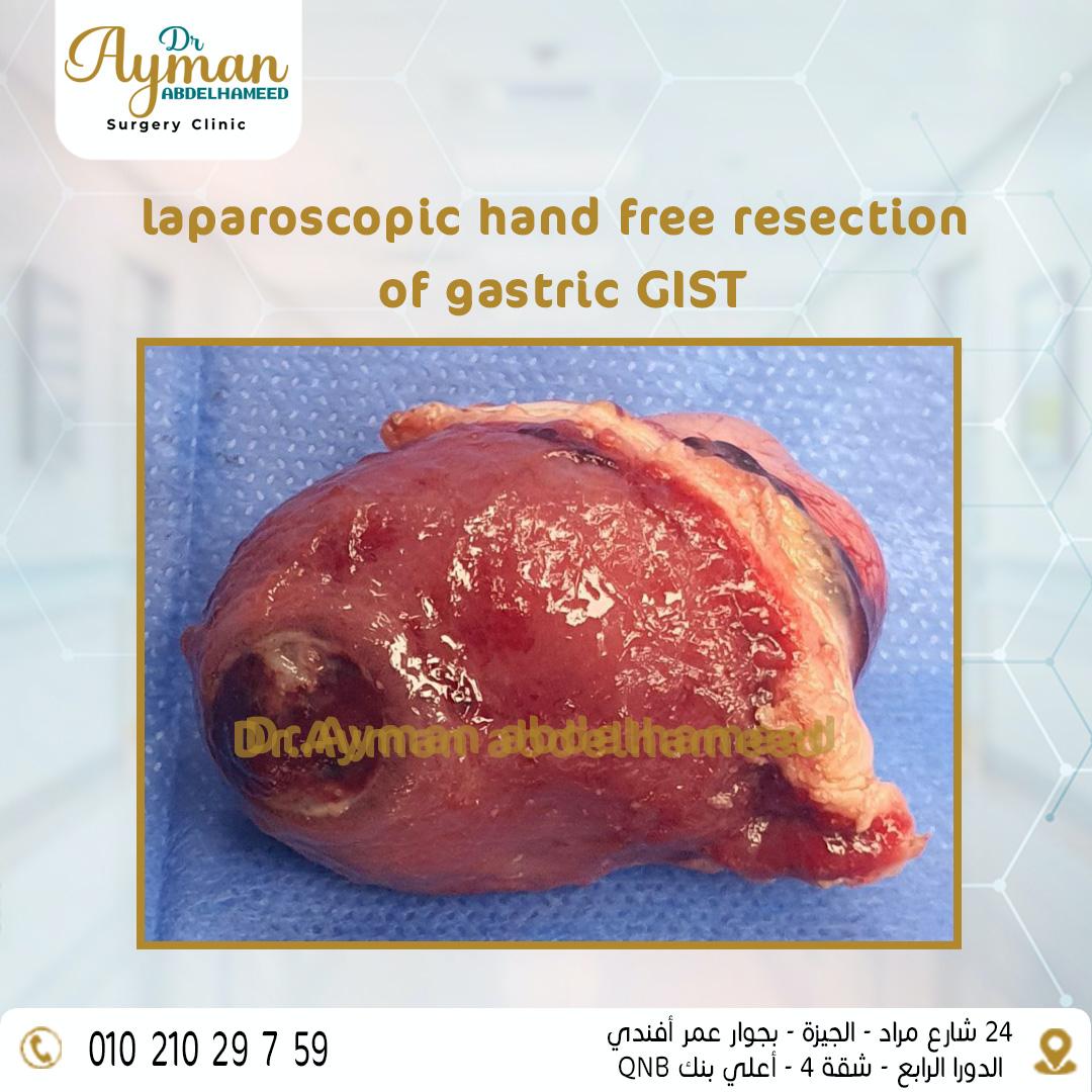 Read more about the article laparoscopic hand free resection of gastric GIST