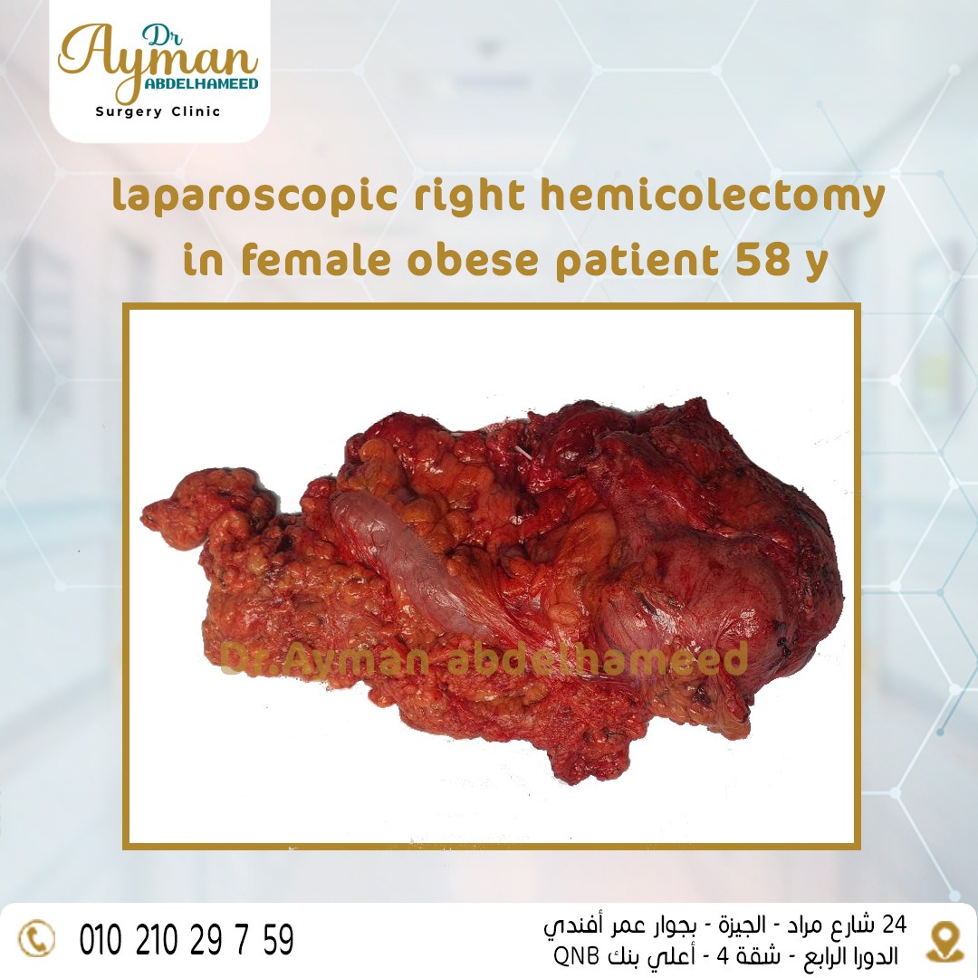 laparoscopic right hemicolectomy