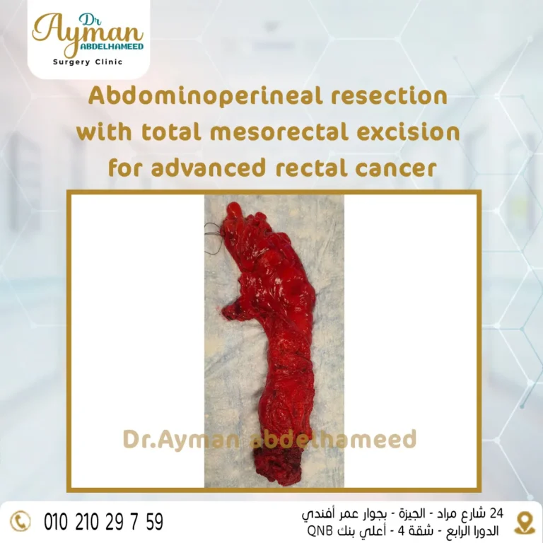 Read more about the article Abdominoperineal resection with total mesorectal excision