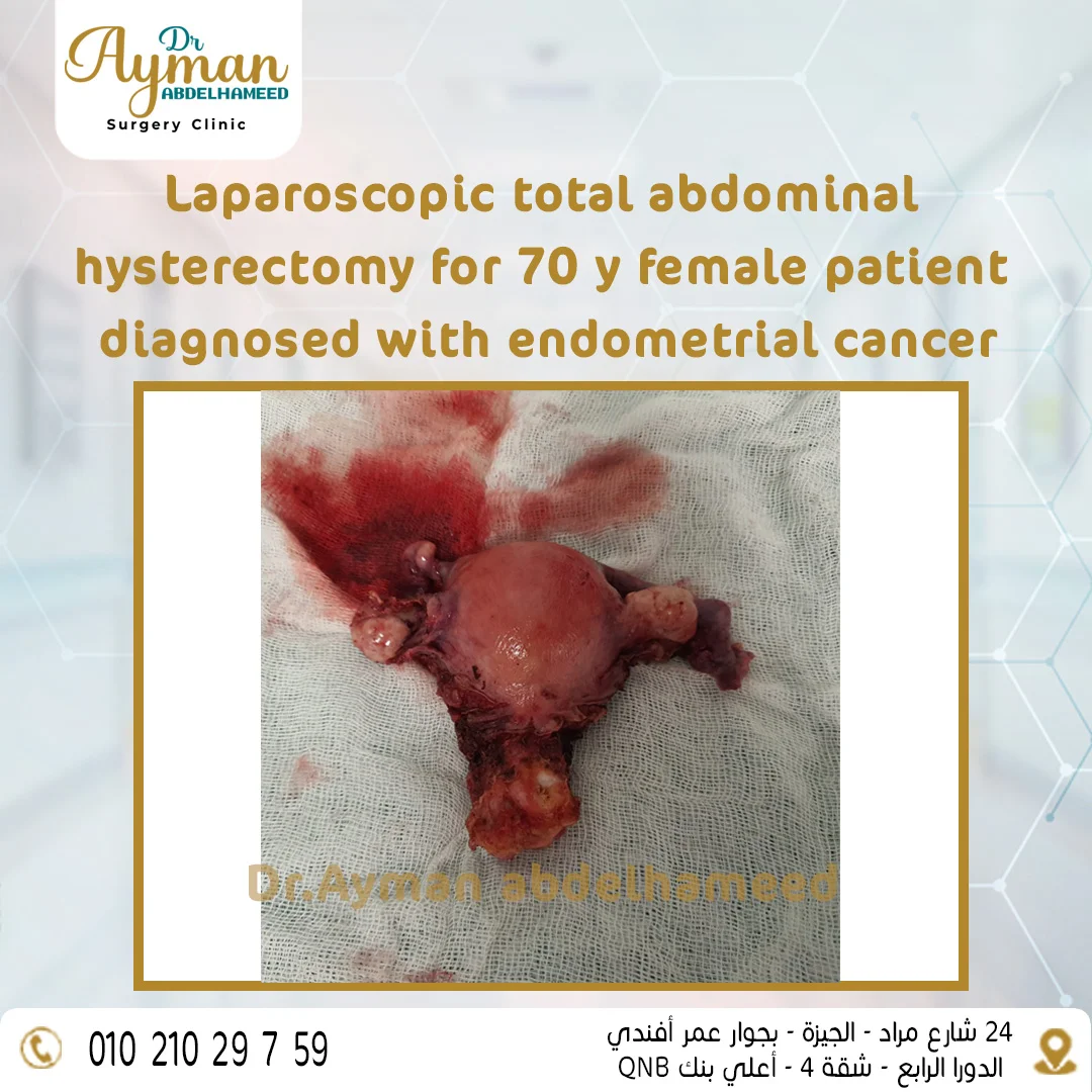 Read more about the article Laparoscopic total abdominal hysterectomy